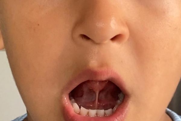 Frenulino... il birichino